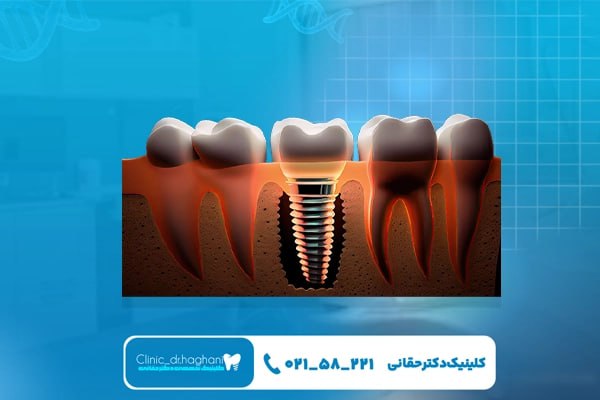 ایمپلنت سوئیسی ایمپلنت سوئیسی