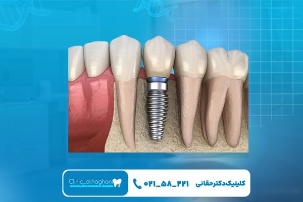 مزیتهای ایمپلنت سوئیسی مزیتهای ایمپلنت سوئیسی