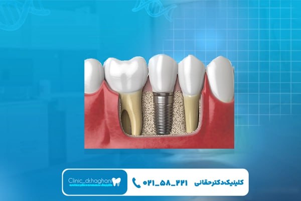 خدمات ایمپلنت سوئیسی در کلینیک دکتر حقانی خدمات ایمپلنت سوئیسی در کلینیک دکتر حقانی