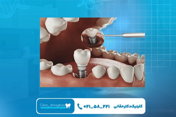 ایمپلنت آلمانی ایمپلنت آلمانی