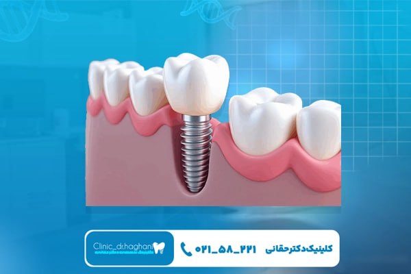 مزایای ایمپلنت آلمانی مزایای ایمپلنت آلمانی