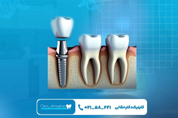 معرفی انواع مختلف ایمپلنت آلمانی معرفی انواع مختلف ایمپلنت آلمانی