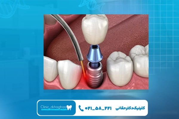 کاربردهای لیزر در کاشت دندان