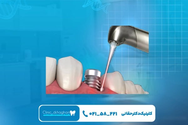محدودیت‌های کاشت دندان با لیزر