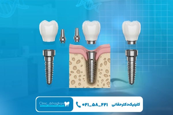کاشت پایه تیتانیومی ایمپلنت