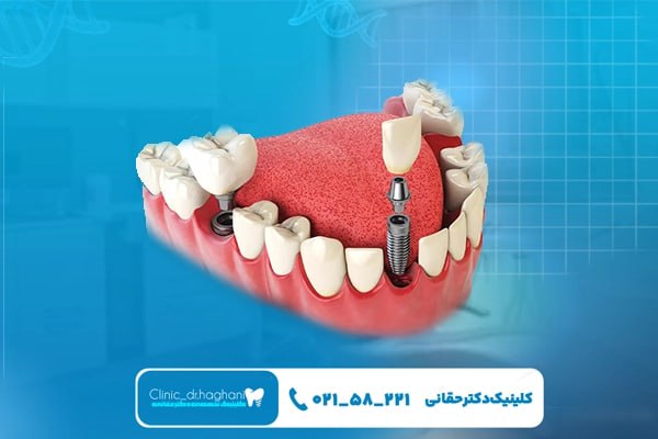 طول عمر ایمپلنت کرهای طول عمر ایمپلنت کرهای