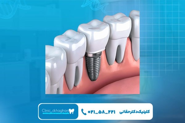 ایمپلنت کرهای ایمپلنت کرهای