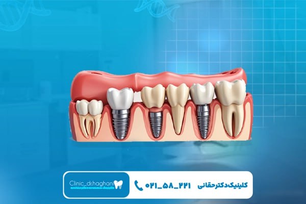 ایمپلنت دیجیتال سه بعدی