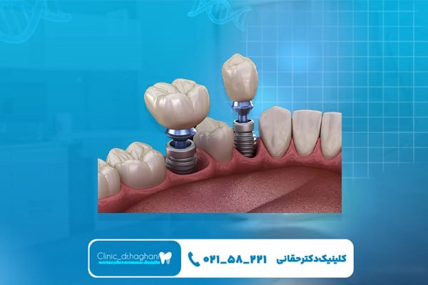 تکنولوژی برش دیجیتال در کاشت ایمپلنت دندان