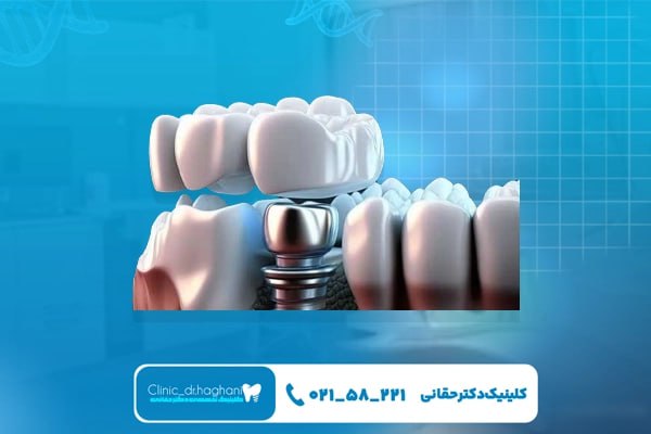  ایمپلنت دندان دیجیتال سه‌بعدی در کلینیک دکتر حقانی