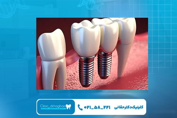 مراحل مختلف ایمپلنت دندان