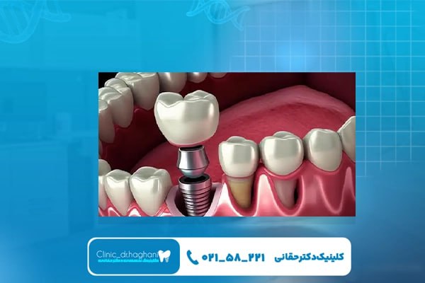 ایمپلنت دندان در غرب تهران