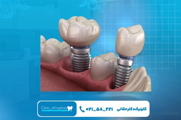 انواع ایمپلنت دندان