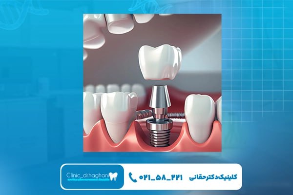 کاشت دندان بدون درد کاشت دندان بدون درد