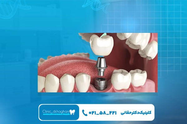 مزیتهای کاشت دندان بدون درد مزیتهای کاشت دندان بدون درد