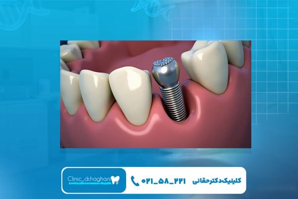 کاشت ایمپلنت دندان بدون درد در کلینیک دندانپزشکی دکتر حقانی کاشت ایمپلنت دندان بدون درد در کلینیک دندانپزشکی دکتر حقانی