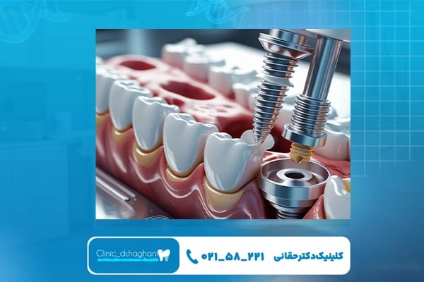 خدمات ویژه کلینیک دکتر حقانی برای موفقیت ایمپلنت