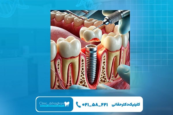 سلامت عمومی بیمار برای موفقیت ایمپلنت