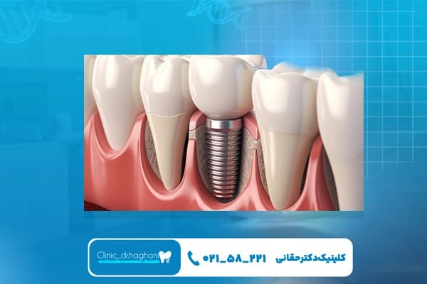 کیفیت استخوان و شرایط محل کاشت ایمپلنت