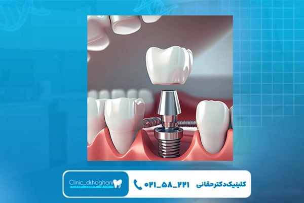 مزیت‌های ویژه دندانپزشکی مدرن ایمپلنت