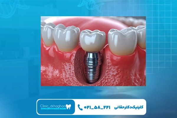 دندانپزشکی مدرن ایمپلنت