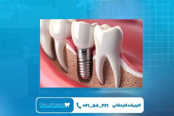 کاشت ایمپلنت دندان