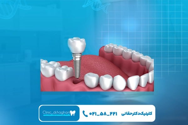 استحکام بالا و کارکرد طبیعی ایمپلنت دندان