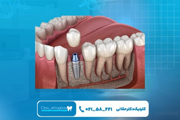 درمان ایمپلنت دندان در کلینیک دکتر حقانی 