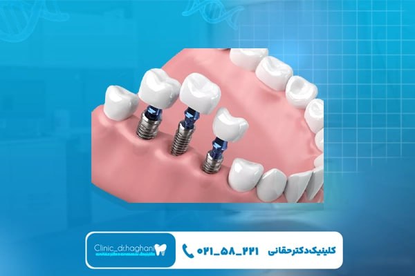 مزیت‌های ایمپلنت دیجیتال برای مراجعه‌کنندگان