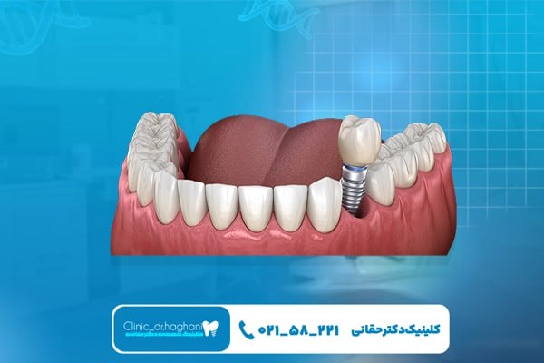 ایمپلنت دیجیتال در کلینیک دندانپزشکی تهران
