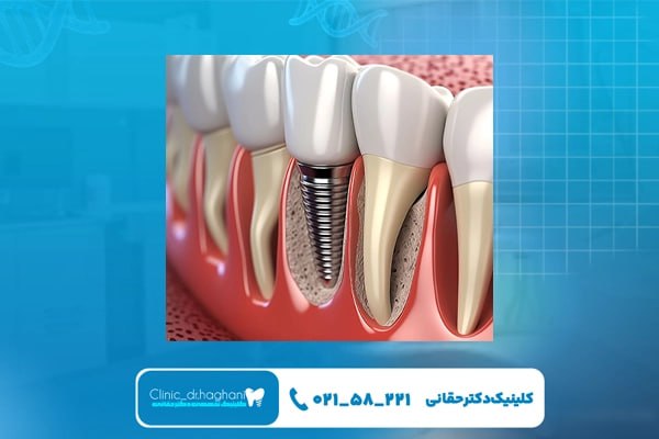 انتخاب کلینیک معتبر برای ایمپلنت در تهران