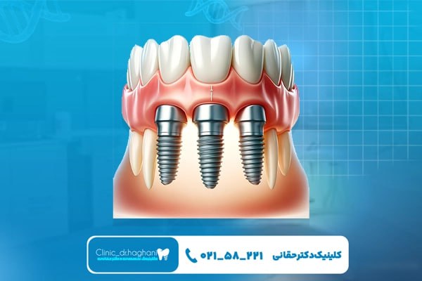 خدمات خاص کلینیک دکتر حقانی در کاشت ایمپلنت
