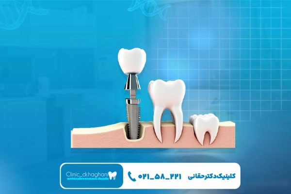 ایمپلنت تمام فک و مینی ایمپلنت دندانی ایمپلنت تمام فک و مینی ایمپلنت دندانی