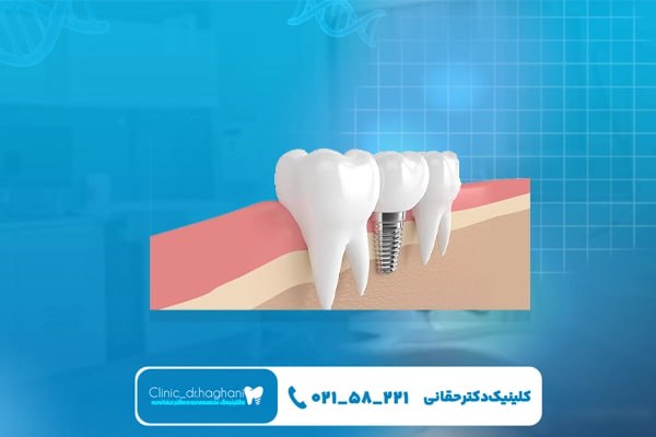 بهترین برند ایمپلنت بهترین برند ایمپلنت