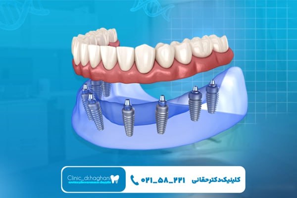 مزیت‌های ایمپلنت دیجیتال نسبت به شیوه سنتی