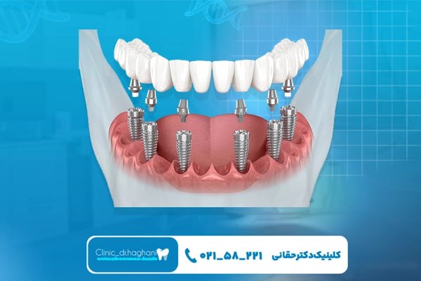 مراحل انجام ایمپلنت دیجیتال در تهران