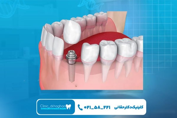 مرکز ایمپلنت دیجیتال جردن