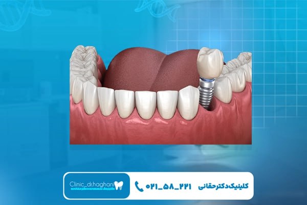 ایمپلنت اقساطی تهران ایمپلنت اقساطی تهران