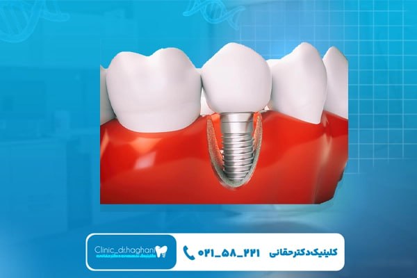 مراحل انجام ایمپلنت دندان قسطی در تهران مراحل انجام ایمپلنت دندان قسطی در تهران