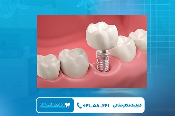 مزیتهای انتخاب طرح اقساطی برای ایمپلنت در تهران مزیتهای انتخاب طرح اقساطی برای ایمپلنت در تهران