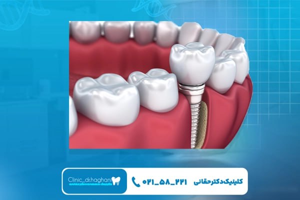مراحل انجام ایمپلنت موفق مراحل انجام ایمپلنت موفق
