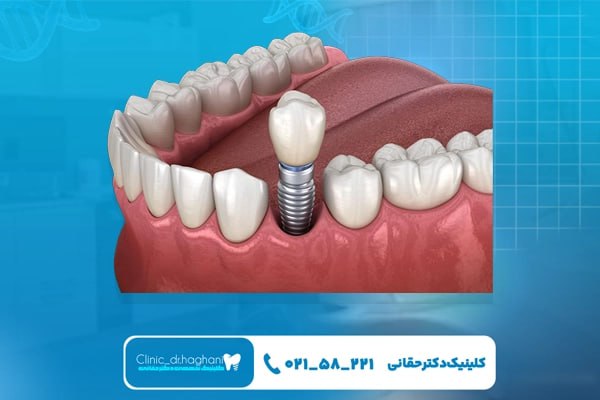 ایمپلنت موفق ایمپلنت موفق