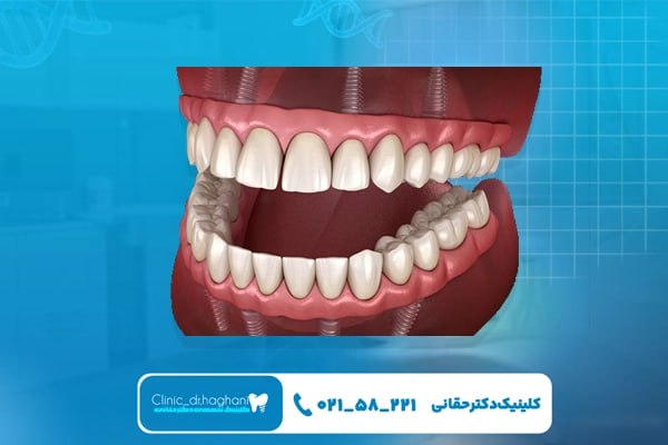 مراقبت بعد از ایمپلنت