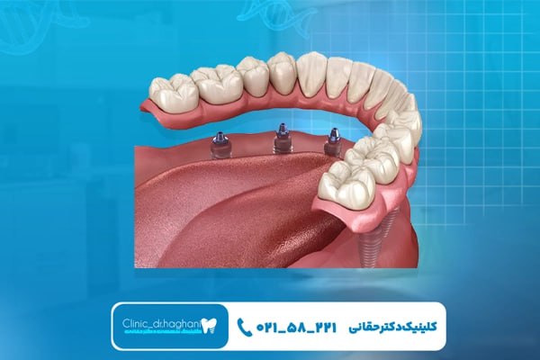 نکات  مراقبتی بعد از ایمپلنت تا ۷۲ ساعت بعد از جراحی
