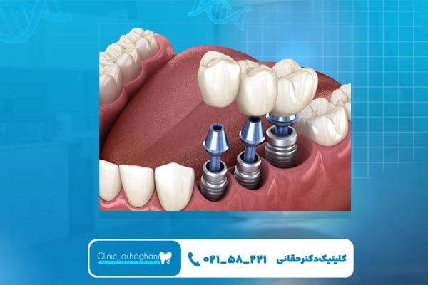 نکات مراقبتی بلندمدت بعد از ایمپلنت دندان