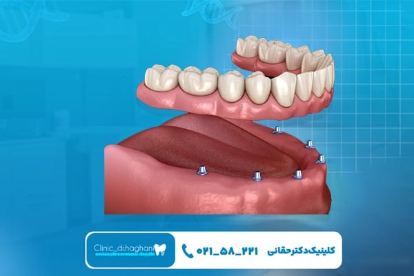 تأثیر بیماری‌ها و داروها بر طول عمر ایمپلنت دندان