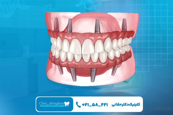 طول عمر ایمپلنت