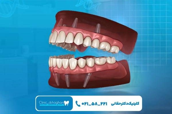 میانگین طول عمر ایمپلنت دندان چقدر است؟