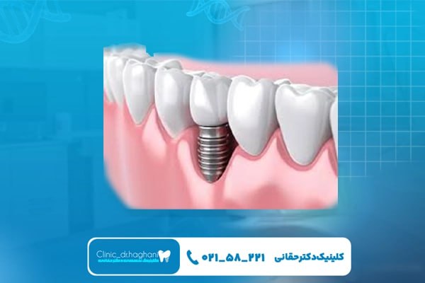 ایمپلنت با ماندگاری بالا