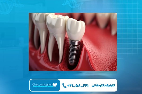 نکات مراقبتی برای افزایش ماندگاری ایمپلنت